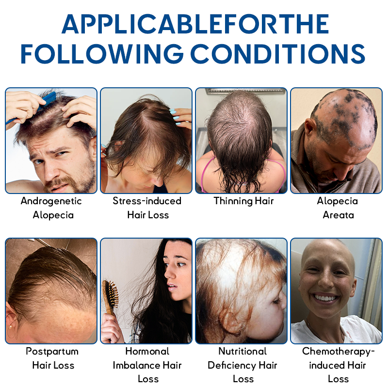 ✅Official Store: ODEIUN™ Advanced Stem Cell Hair Revival Roller 🌿💡 – Natural Formula, Visible Results in 7 Days(🔥UP TO 80% OFF)