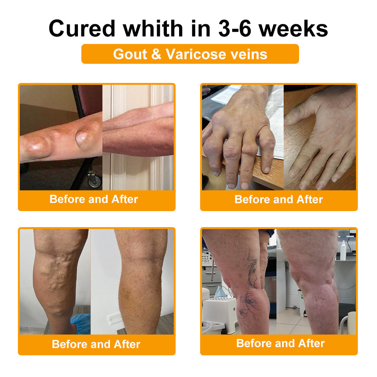 🎁Flash Sale - ODALIT™ Botulinum Toxin & Bee Venom Pain-Relief Bone Healing Cream)