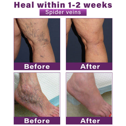 ✅Seurico™ Polidocanol Nano Varicose Vein Patch Recommended by the Society for Vascular Surgery