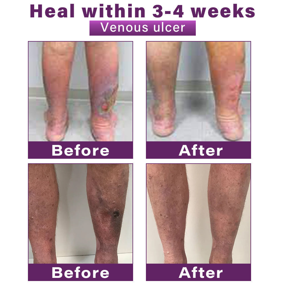 ✅Seurico™ Polidocanol Nano Varicose Vein Patch Recommended by the Society for Vascular Surgery