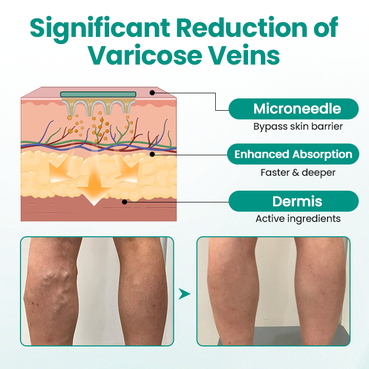 Seurico™ VeinRevive Leg Varicosity Treatment Patch