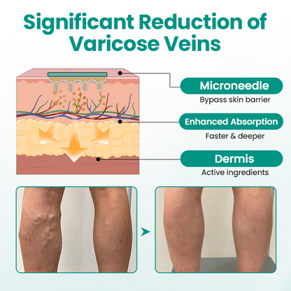 Seurico™ VeinRevive Leg Varicosity Treatment Patch