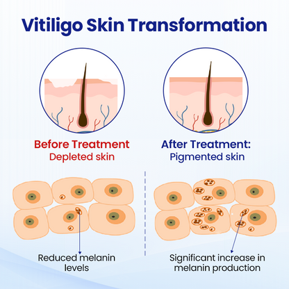 ODEIUN™ Vitiligo Treatment Spray 🌿 Fade Spots Restore Confidence 🌞