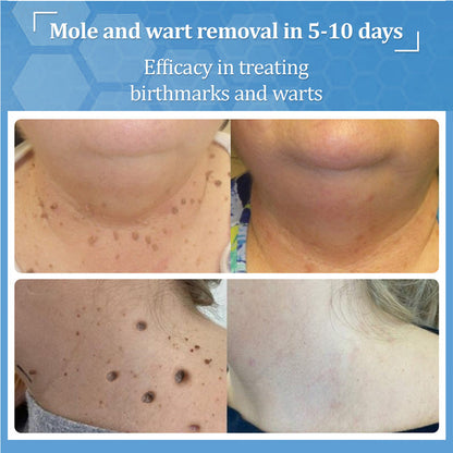 👩‍⚕️LBMLBM™ BeeDerm RX Cream, Painless, easy and gentle fix for warts, skin tags, lumps, infections, cysts and scars