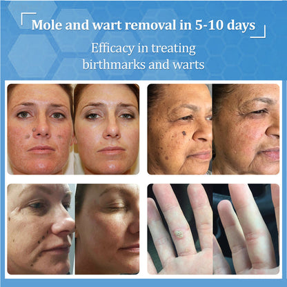 👩‍⚕️LBMLBM™ BeeDerm RX Cream, Painless, easy and gentle fix for warts, skin tags, lumps, infections, cysts and scars