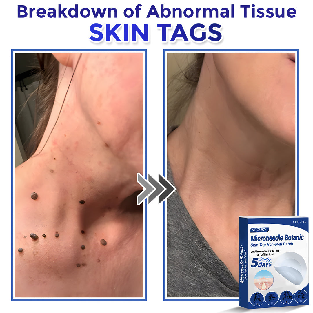 ✅Negusy™ MicroNeedle Botanic Skin Tag Removal Patches – 🇺🇸 Made in the USA | Fast, Painless, Plant-Powered