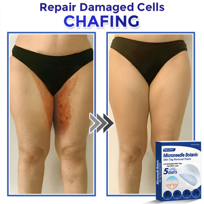 ✅Negusy™ MicroNeedle Botanic Skin Tag Removal Patches – 🇺🇸 Made in the USA | Fast, Painless, Plant-Powered