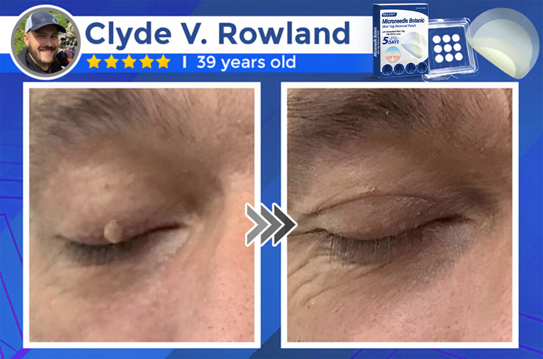 ✅Negusy™ MicroNeedle Botanic Skin Tag Removal Patches – 🇺🇸 Made in the USA | Fast, Painless, Plant-Powered