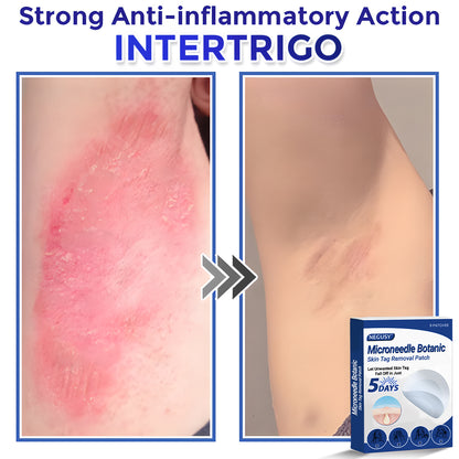 ✅Negusy™ MicroNeedle Botanic Skin Tag Removal Patches – 🇺🇸 Made in the USA | Fast, Painless, Plant-Powered