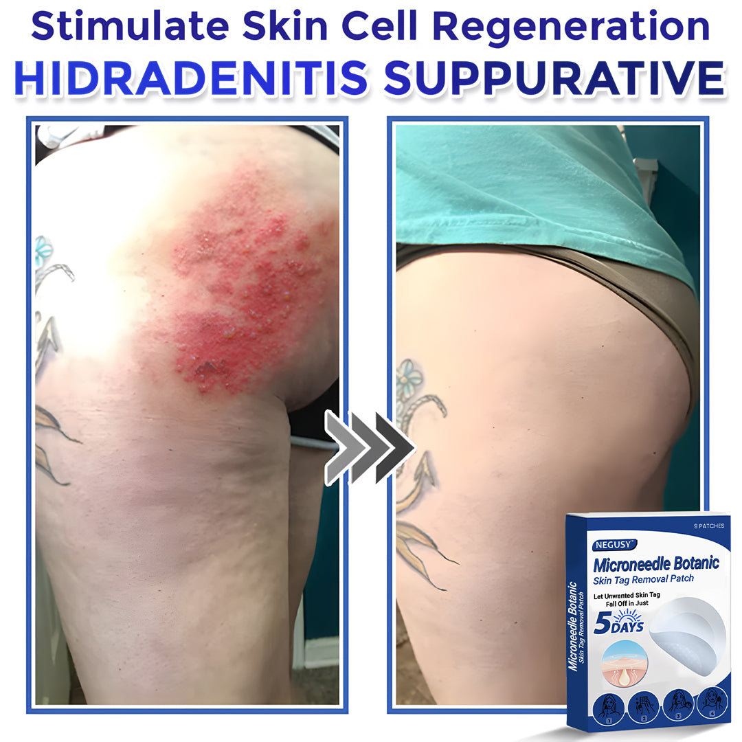 ✅Negusy™ MicroNeedle Botanic Skin Tag Removal Patches – 🇺🇸 Made in the USA | Fast, Painless, Plant-Powered