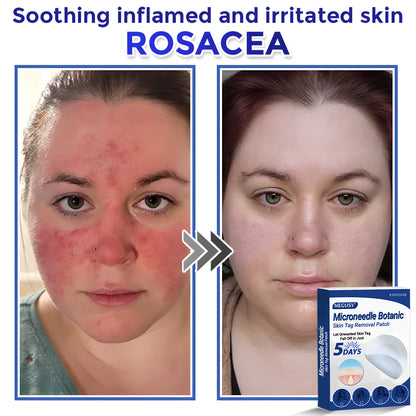 ✅Negusy™ MicroNeedle Botanic Skin Tag Removal Patches – 🇺🇸 Made in the USA | Fast, Painless, Plant-Powered