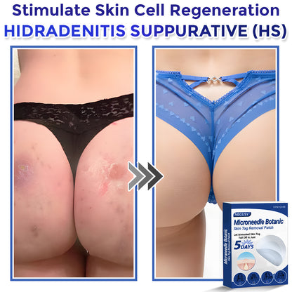 ✅Negusy™ MicroNeedle Botanic Skin Tag Removal Patches – 🇺🇸 Made in the USA | Fast, Painless, Plant-Powered