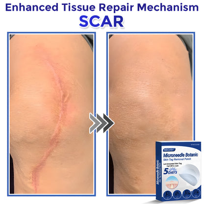 ✅Negusy™ MicroNeedle Botanic Skin Tag Removal Patches – 🇺🇸 Made in the USA | Fast, Painless, Plant-Powered