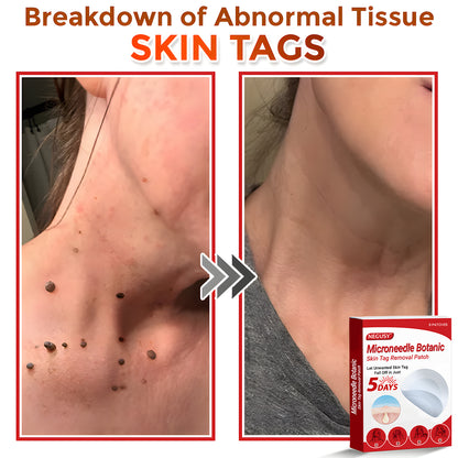 Negusy™ MicroNeedle Botanic Skin Tag Removal Patches – 🇺🇸 Made in the USA | Fast, Painless, Plant-Powered
