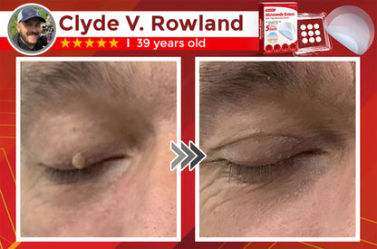 Negusy™ MicroNeedle Botanic Skin Tag Removal Patches – 🇺🇸 Made in the USA | Fast, Painless, Plant-Powered