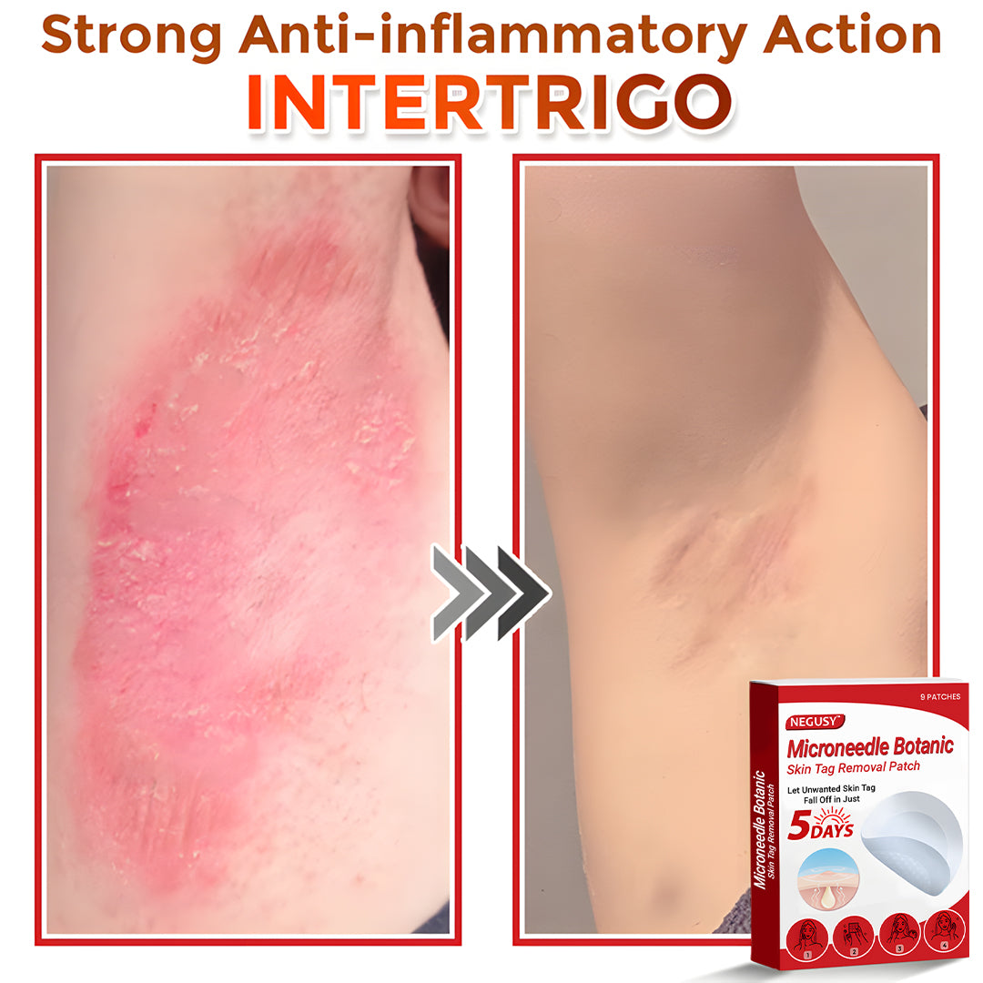 Negusy™ MicroNeedle Botanic Skin Tag Removal Patches – 🇺🇸 Made in the USA | Fast, Painless, Plant-Powered