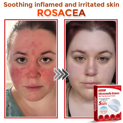 Negusy™ MicroNeedle Botanic Skin Tag Removal Patches – 🇺🇸 Made in the USA | Fast, Painless, Plant-Powered