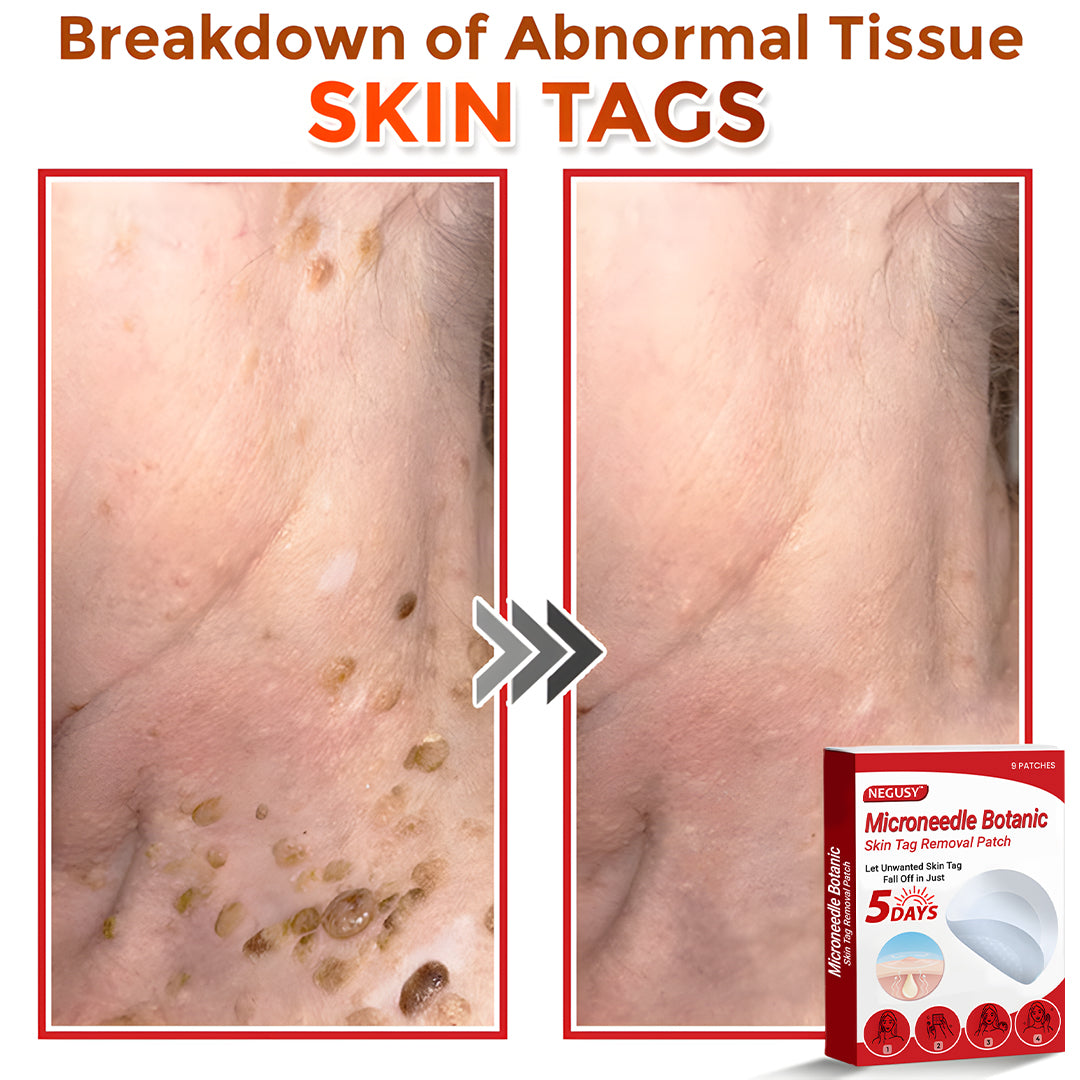 Negusy™ MicroNeedle Botanic Skin Tag Removal Patches – 🇺🇸 Made in the USA | Fast, Painless, Plant-Powered