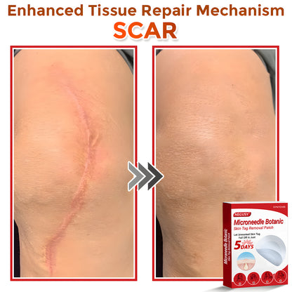 Negusy™ MicroNeedle Botanic Skin Tag Removal Patches – 🇺🇸 Made in the USA | Fast, Painless, Plant-Powered