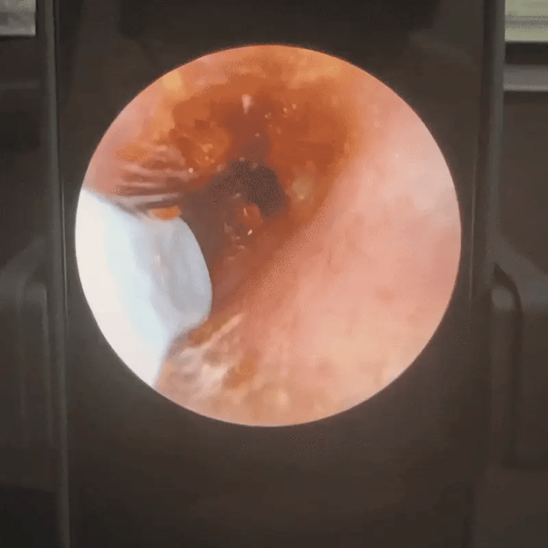 Zakdavi™ ProClean Earwax Removal Tool