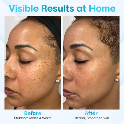 ✅ ODEIUN™ Professional Mole Removal Serum – Trusted Dermatological Formula 🩺