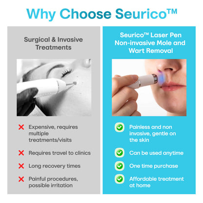Seurico™ Laser Pen – Non-Invasive Mole and Wart Removal 1–3 days