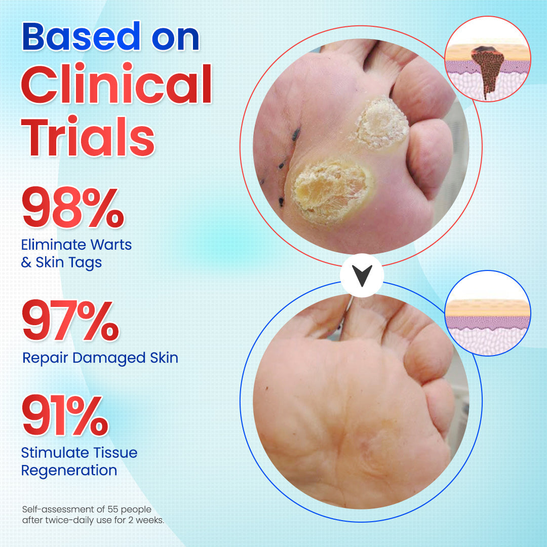 Odeiun™ Clearfrost Cryo Relief Spray🔥 – Advanced Wart & Skin Tag Removal Solution