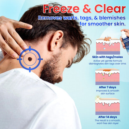 Odeiun™ Clearfrost Cryo Relief Spray🔥 – Advanced Wart & Skin Tag Removal Solution