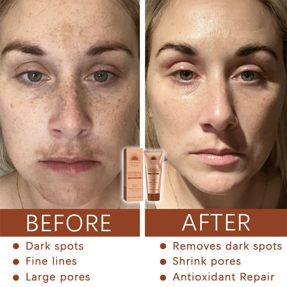 🏵️ Zakdavi™ Whitening and Spot-Removing Face Mask Suitable for face and body – 👩‍⚕️ Natural ingredients permanently remove age spots, freckles, sun spots, and liver spots.