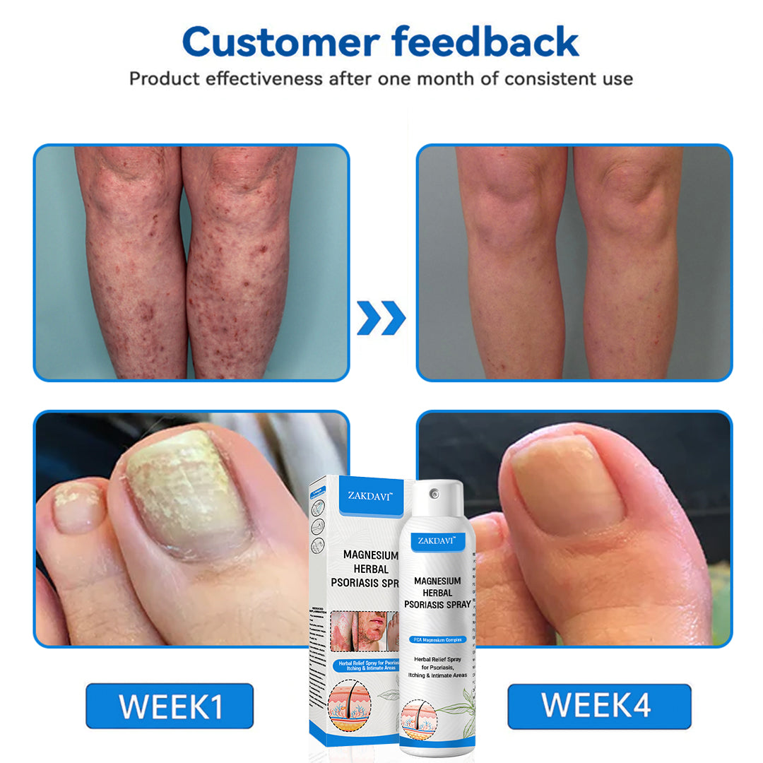✅Official Store:  Zakdavi™ Magnesium Herbal Psoriasis Spray – FDA Certified Relief for Psoriasis, Eczema & Skin Tags