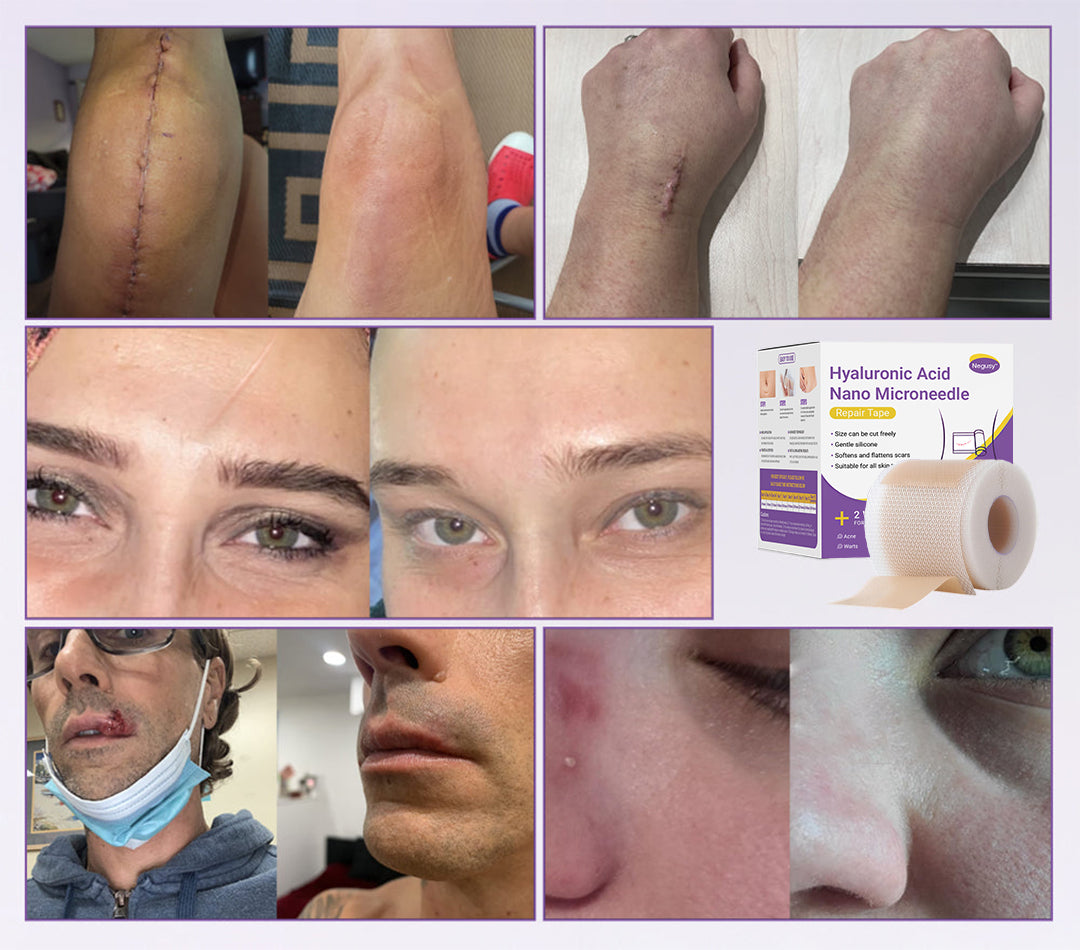 ✅Official Store |Negusy Hyaluronic Acid Nano Microneedle Repair Tape🗽🏥(Treatment of old and new scars, reduction of surgical scars, stretch marks, keloids, acne, burns, warts, dermatomes and varicose veins)