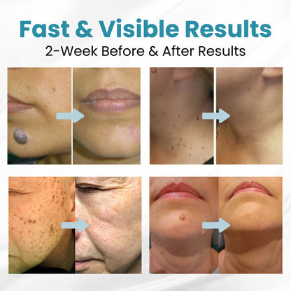 ✨Seurico™ Laser Pen - Non-invasive Mole and Wart Removal