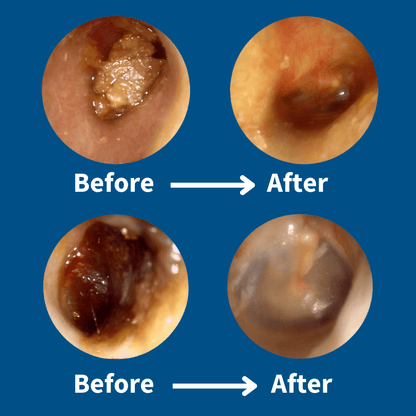 Zakdavi™ ProClean Earwax Removal Tool