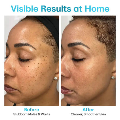 ✨Seurico™ Laser Pen - Non-invasive Mole and Wart Removal