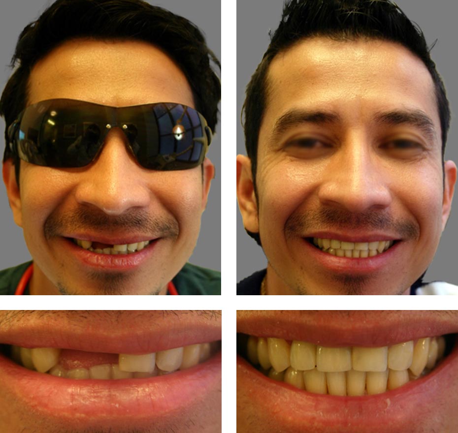 Seurico™ Instant Tooth Repair Gel – No Drills, No Pain, Fast at Home Fix!