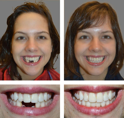 Seurico™ Instant Tooth Repair Gel – No Drills, No Pain, Fast at Home Fix!