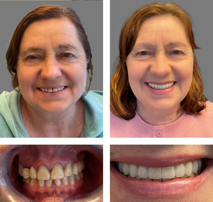 Seurico™ Instant Tooth Repair Gel – No Drills, No Pain, Fast at Home Fix!