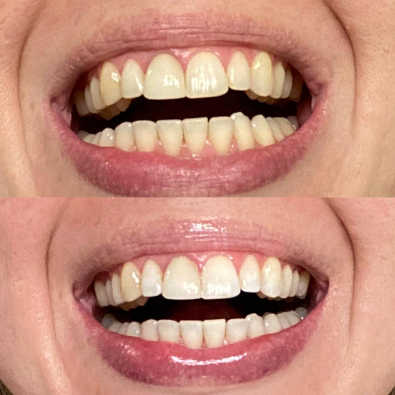 TeethRestoration Mineral Whitening & Repair Powder 🦷 (ADA Recommended)