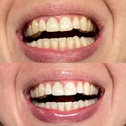 TeethRestoration Mineral Whitening & Repair Powder 🦷 (ADA Recommended)